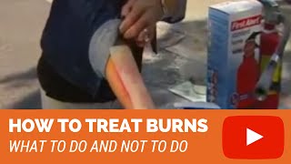 How To Treat Burns 2nd degree 3rd degree burns [upl. by Nuawtna581]