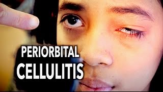 PERIORBITAL CELLULITIS Painful  Dr Paul [upl. by Beauchamp]