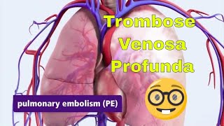 Trombose Venosa Profunda TVP e Embolia Pulmonar EP [upl. by Naie]