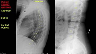 Introduction to Spine Radiographs [upl. by Mell572]