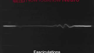 EMG Fasciculations [upl. by Niven]