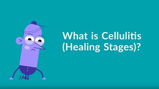 Cellulitis Healing Stages [upl. by Caspar]