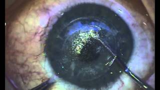 ReLEx SMILE Minimally invasive laser eye surgery [upl. by Anthony405]