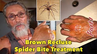 Brown Recluse Spider Bite Treatment Part 1  Dr Robert Cassar [upl. by Carrillo]