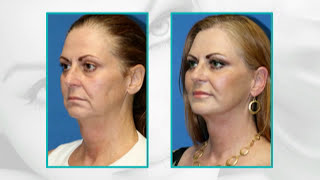 Facial Plastic Surgery Before and After 15 Years Younger Facelift facial fat transfer eyelid [upl. by Llenor]