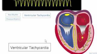 ECG Rhythm Review Ventricular Tachycardia Torsades de points Asystole [upl. by Daye]