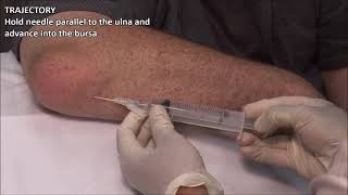 Olecranon Bursitis  Aspiration and Injection  In Vivo Series [upl. by Penelopa]