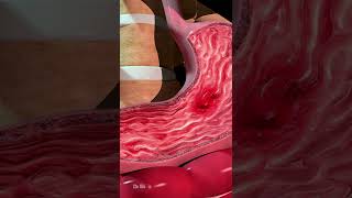 Formation of an Ulcer in the Stomach [upl. by Eenoj]