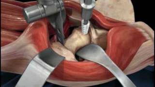 Total Hip Replacement Using MAKO Robotic Assistance [upl. by Etterb347]