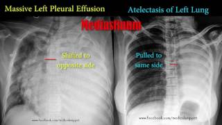 Anatomy Thorax Overview  Ribs Sternal angle Pleura and Pneumothorax [upl. by Anilatsyrc]