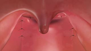 Sphincter Pharyngoplasty to Treat VPI [upl. by Craner]