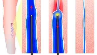 Comment se soignent les varices [upl. by Hammer]