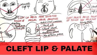 Cricopharyngeal Dysfunction Difficulty Swallowing Especially Solid Foods [upl. by Aicats390]