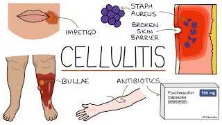 Understanding Cellulitis Skin and Soft Tissue Infections [upl. by Nyliuqcaj]