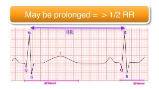 ECG basics 1010  The QT Interval [upl. by Kathi]