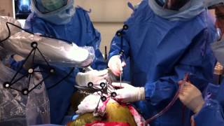 Knee replacement using the Stryker Mako Robot [upl. by Nonaihr]