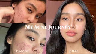 How I Cleared my Acne somehow PHILIPPINES  Lj Torres [upl. by Aienahs993]