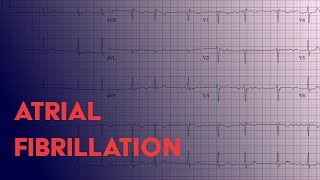 Ventricular Fibrillation V Fib amp Sudden Cardiac Death [upl. by Obadias]