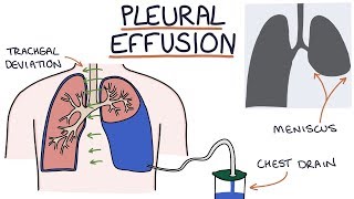 Epanchement pleural  Docteur Synapse [upl. by Rosamond]