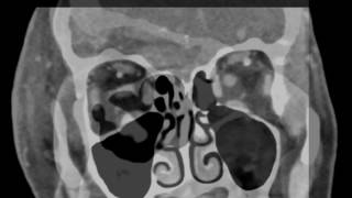 Periorbital Cellulitis [upl. by Curkell991]