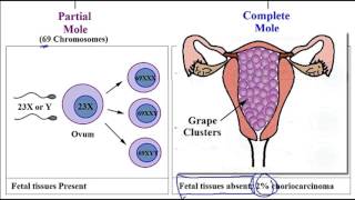 Video 254 Hydatidiform Mole Molar Pregnancy Partial vs Complete Mole amp Associated Risk Factors [upl. by Latrena]