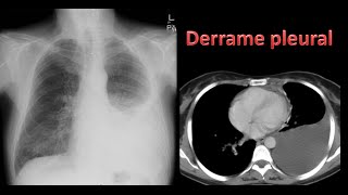 Derrame pleural [upl. by Peltz648]