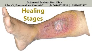 Cellulitis Infection healing stages [upl. by Townsend514]