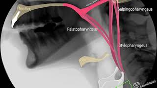 4 Ways to Treat Velopharyngeal Insufficiency VPI [upl. by Agatha]