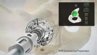 MAKO RoboticArm Total Knee Replacement  Part 1 [upl. by Pasia]