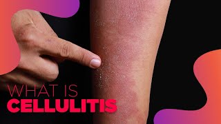 What is Cellulitis  Symptoms and Treatment Options [upl. by Kathryn58]