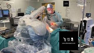 MAKOplasty RoboticAssisted Surgery for Partial Knee Replacement [upl. by Zakarias904]